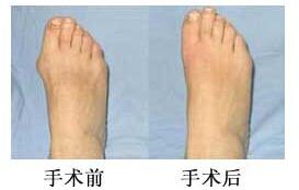 麗水拇外翻（大腳骨）矯正價格