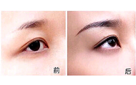 臺(tái)州切眉價(jià)格