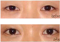 臺(tái)州眼瞼缺損整復(fù)術(shù)價(jià)格