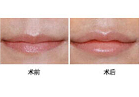 舟山薄唇增厚價格