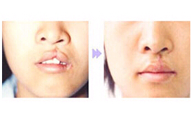 臺(tái)州唇裂修復(fù)價(jià)格