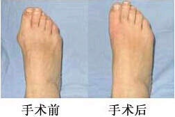 臺州拇外翻（大腳骨）矯正價格