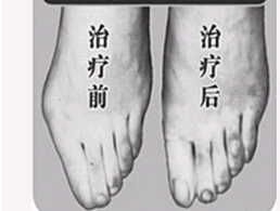 臺州寬腳變窄價格