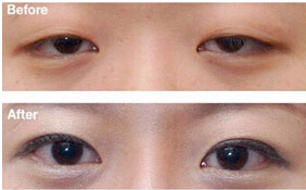 衢州眼瞼下垂矯正價格