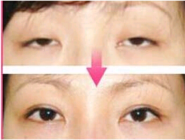衢州瞼眶溝填充價格