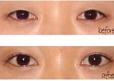 衢州眼瞼缺損整復價格