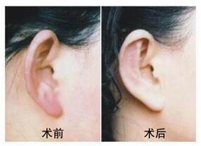 麗水招風耳矯正價格