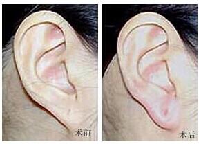麗水耳垂加大價(jià)格