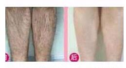 衢州大小腿脫毛價(jià)格