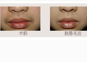 濟(jì)寧脫唇毛價(jià)格