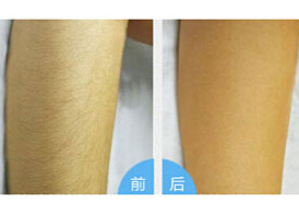 濟寧手臂脫毛價格