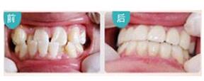 衢州牙齒矯正價(jià)格