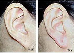 濟(jì)寧耳垂加大價(jià)格