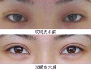 金華雙眼皮失敗修復(fù)價格