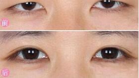 麗水眼瞼下垂矯正價(jià)格