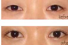南平眼瞼缺損整復(fù)術(shù)價(jià)格