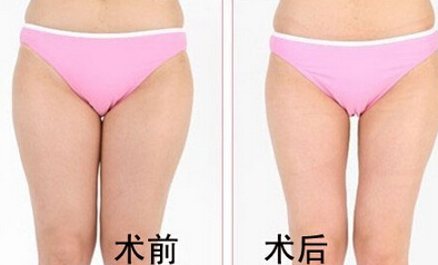 女生大象腿咋整呢？