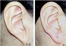 南平穿耳孔價格