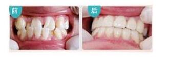 南平牙齒矯正價格