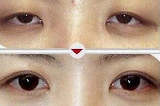 湛江上瞼松弛矯正價格