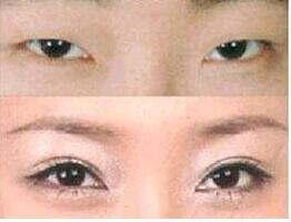 湛江眼瞼下垂矯正價(jià)格