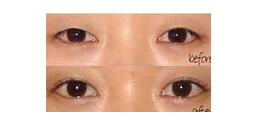湛江瞼眶溝填充價(jià)格