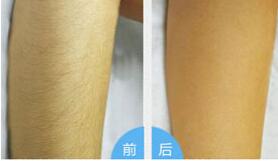 湛江前臂脫毛價格