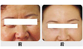 濟(jì)寧射頻除皺價(jià)格