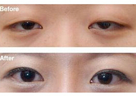 江門眼瞼下垂矯正價格