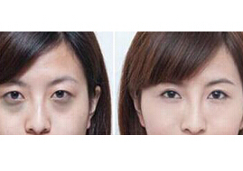 江門去黑眼圈價格