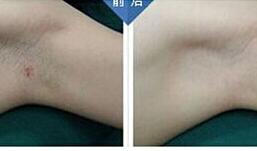 湛江去除腋臭價格