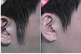 金華發際線脫毛價格