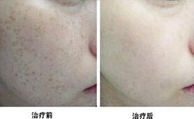 金華雀斑價格