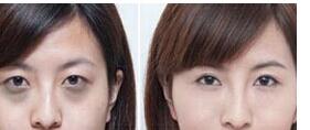河源去黑眼圈價格