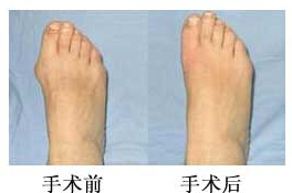 江門拇外翻（大腳骨）矯正價格