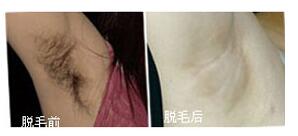 河源脫腋毛價格