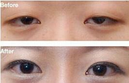 陽江眼瞼下垂矯正手術價格