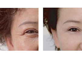 汕尾眼部除皺價(jià)格