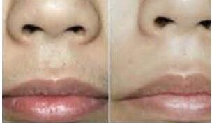 陽江脫絡腮胡價格
