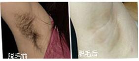 陽江脫腋毛價格