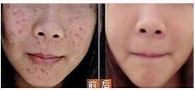 河源微針美塑價格