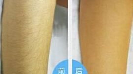清遠手臂脫毛價格