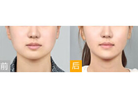 臨沂瘦臉針價(jià)格