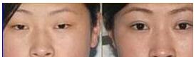莆田瞼眶溝填充價格