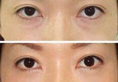 莆田去黑眼圈價(jià)格