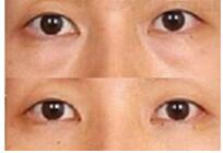 莆田眼瞼粘連術價格