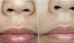 莆田脫落腮胡價格