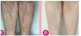 莆田大小腿脫毛價(jià)格