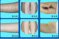 莆田全身脫毛價格
