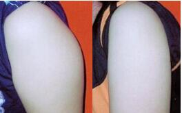 莆田水動(dòng)力安全吸脂價(jià)格